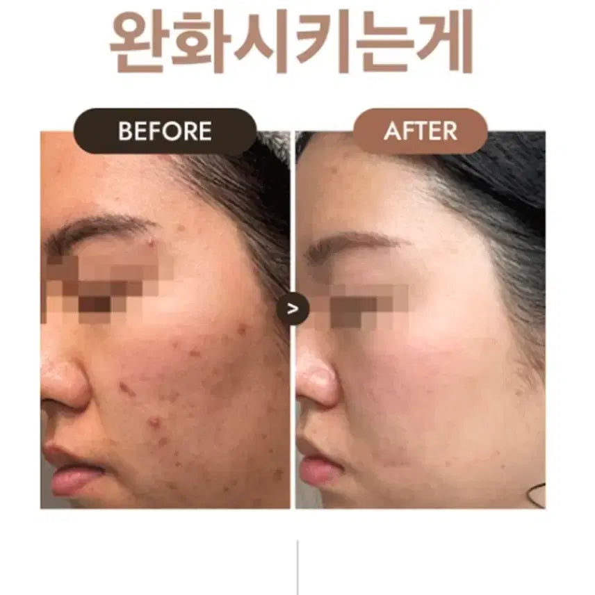 [BUNJANG] Charcoal Cleansing Foam for Acne, Blackheads, and Pores / 임상12가지완료 화농성 좁쌀 여드름 숯카마 피지 블랙헤드노폐물 제거 클렌징폼